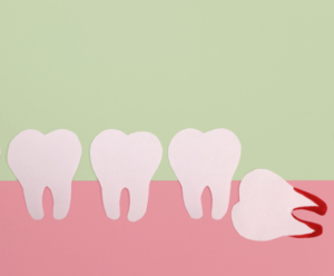 removing wisdom teeth