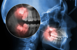 Wisdom teeth removal